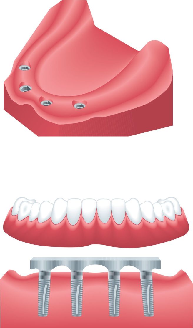 Implant Dentist Seattle