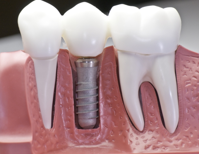 Seattle Dental Implants
